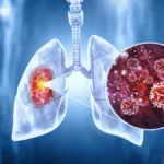 ¿Qué es el Cáncer de Pulmón?